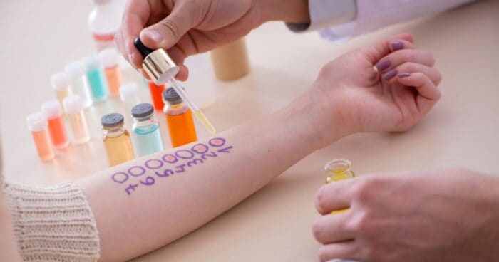 The skin prick test is one of the most common allergy tests.