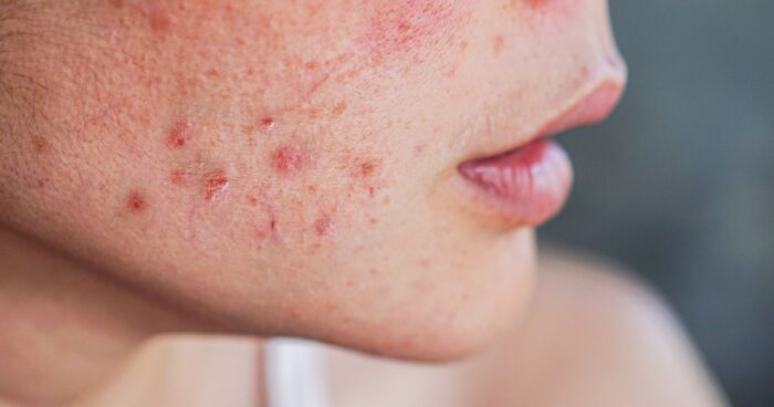 An allergic reaction on the face is caused by contact with allergens, which can include certain cosmetic ingredients, food allergens, or environmental substances. Acne is caused by inflamed sebaceous glands, with contributing factors including genetics, hormonal changes, and bacteria.