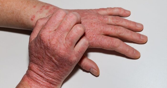 Latex allergy symptoms can vary from person to person. They may not appear immediately after contact with latex but can develop gradually with repeated exposure.