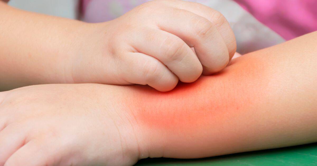 Symptoms of sun allergy in children appear anywhere from a few minutes to several hours after sun exposure. The main symptom is a sun rash.