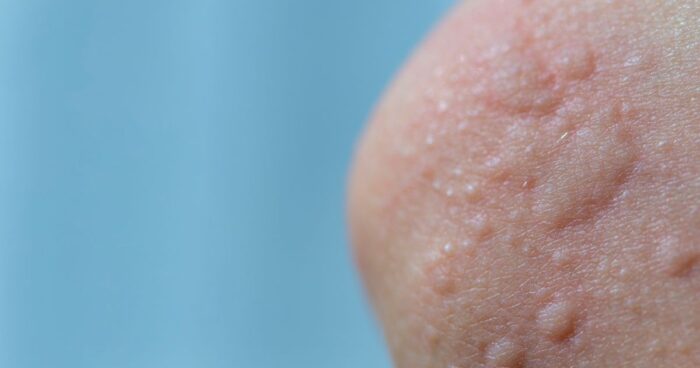 Hives, also known as urticaria, is a skin condition caused by contact with an allergen or physical irritation of the skin. It can also be associated with vasculitis, a group of diseases caused by inflammation of blood vessel walls.