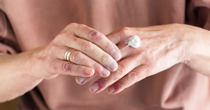 For eczema, use hypoallergenic moisturising creams that restore moisture to dried-out skin.