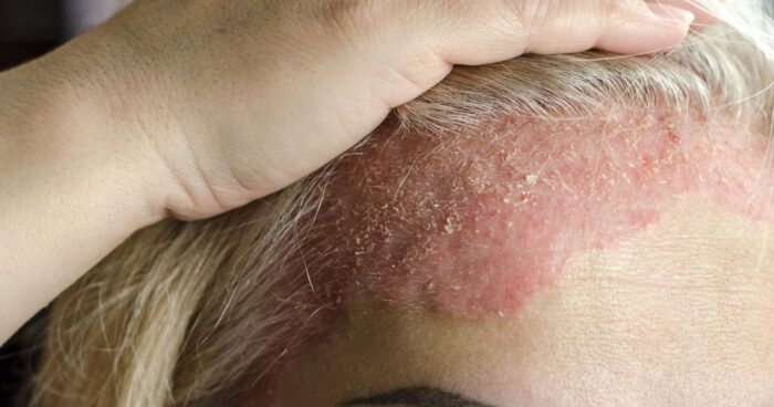 Eczema, also known as dermatitis, is an inflammatory skin condition. It most commonly presents as itching, redness, and a rash.