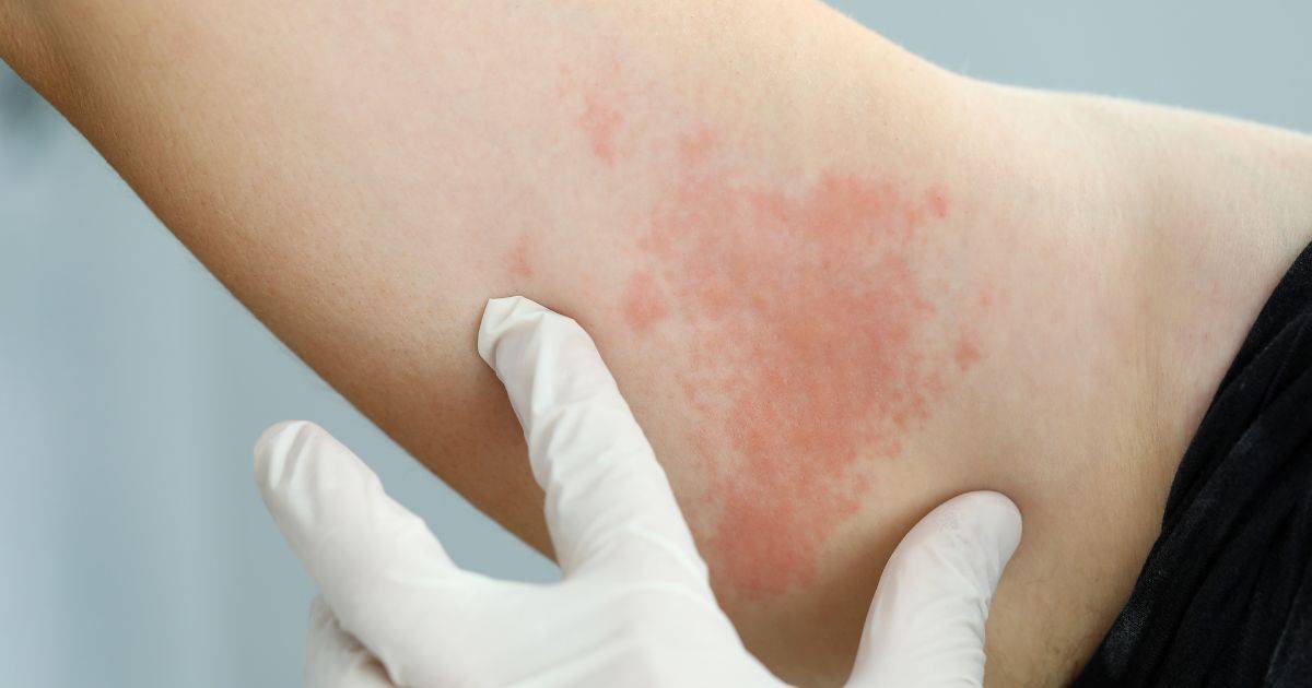 Histamine intolerance symptoms include digestive issues (bloating, diarrhoea, or constipation), headaches and migraines, itching, rashes or hives, fatigue and drowsiness, runny nose, sneezing, insomnia or sleep disturbances, muscle and joint pain, anxiety or nervousness, and worsening of menstrual symptoms.