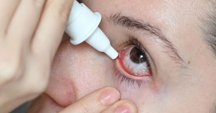 Treating allergic conjunctivitis involves eye drops and prevention.