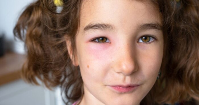 Typical symptoms of a facial allergy include red patches, rash, swelling, itching, watery eyes, and sneezing.