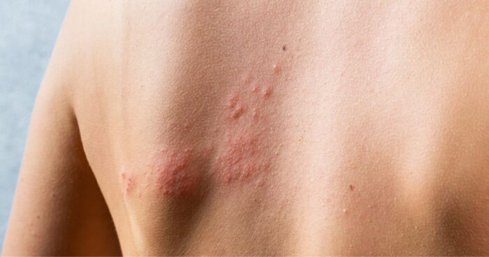 how to identify atopic eczema — Atopic eczema, also known as atopic dermatitis, is a chronic inflammatory skin condition.