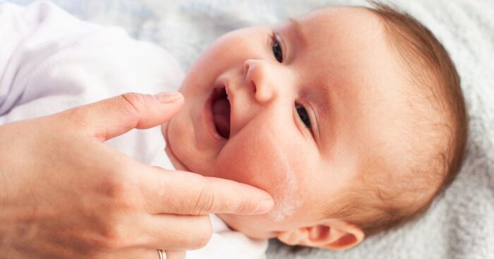 how to identify atopic eczema — In infants, atopic eczema presents as an itchy rash and blisters on the cheeks.