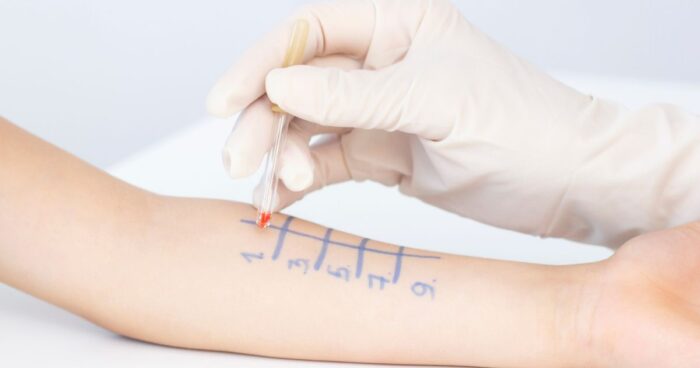 If you suspect that a particular allergen is causing you problems, you can start with a home allergy test. Should the result confirm an allergy, it's essential to see an allergist. Either skin or blood tests are carried out to pinpoint the exact diagnosis, which then guides the right course of treatment.