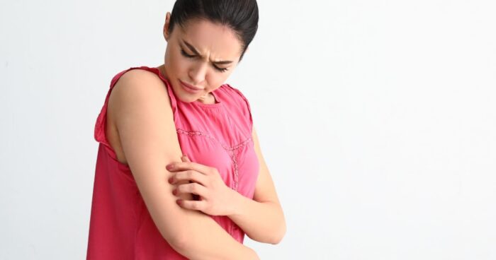 Hives — the symptoms of urticaria resemble nettle stings, typically presenting as an eruption of raised bumps that sometimes merge together.