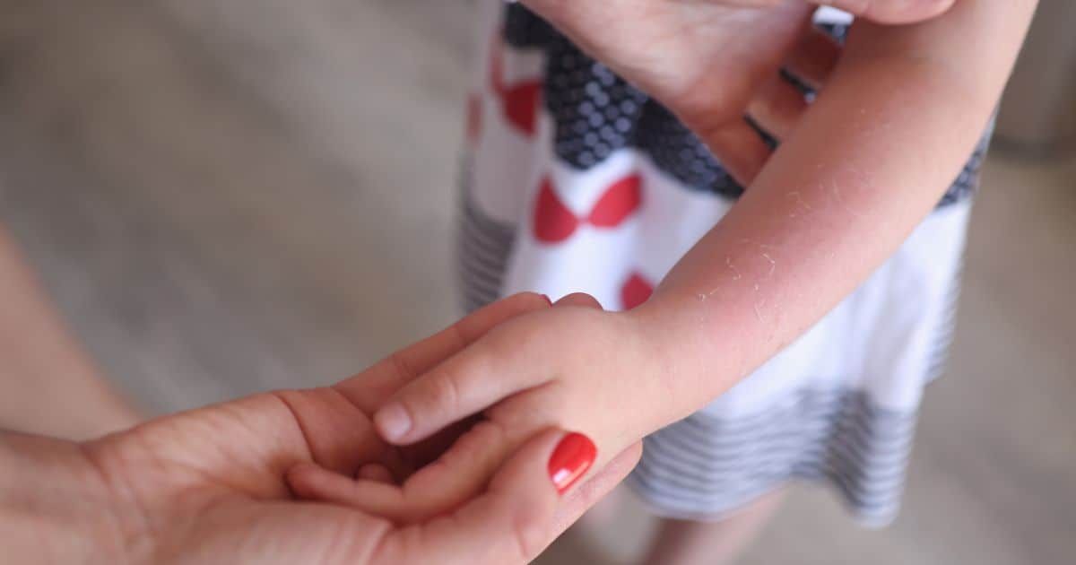 Atopic eczema in children is a chronic inflammatory skin condition. Several factors can drive its development.