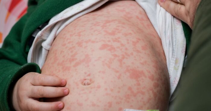 Hives in children are usually shorter-lived, but that's not always the case. The biggest problem with this skin condition in children is the itching. Children tend to scratch their hives — sometimes until they bleed — which needs to be prevented to avoid infection.