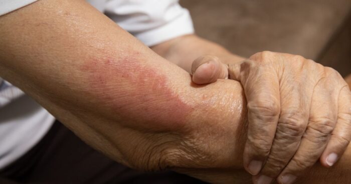 Watch for signs of an allergic reaction such as itching, swelling, rash, difficulty breathing, vomiting, or dizziness.