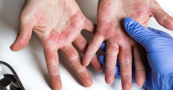 how to identify atopic eczema — Typical symptoms of atopic eczema include itching, skin redness, dry or flaky skin, and a rash.