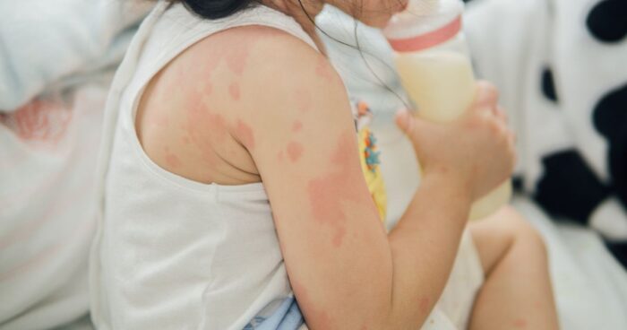 Several factors influence the development of eczema, including genetics, diet, stress, allergies, environment, hygiene habits, hormonal changes, and the immune system.