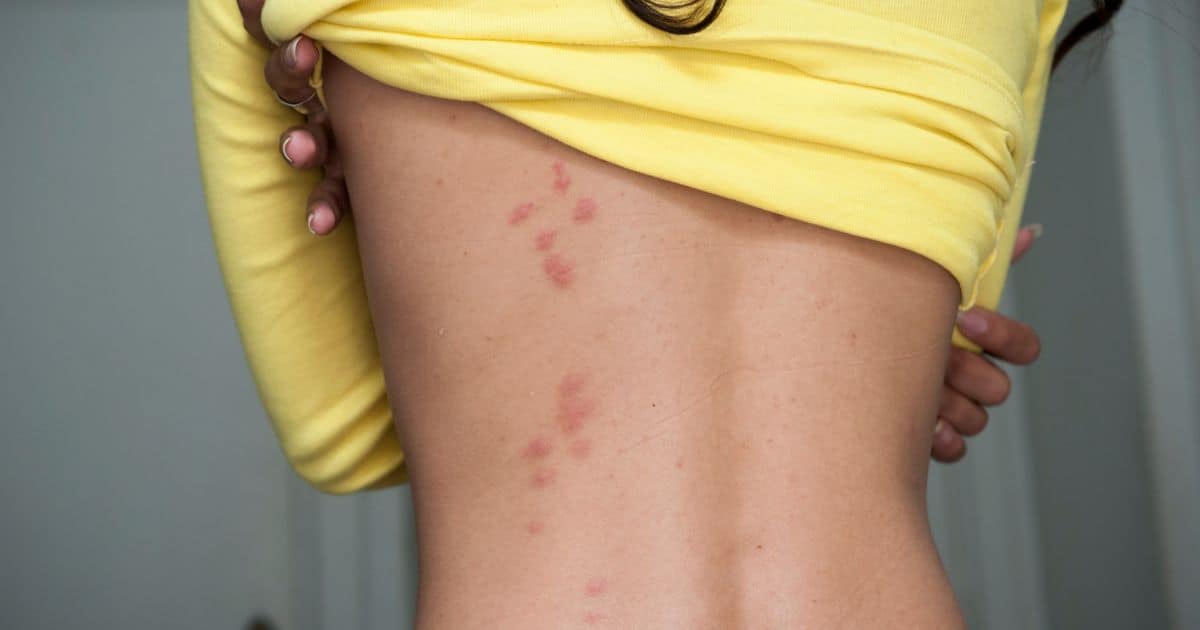 fleas in bed — flea bites on skin with a typical red dot in the centre