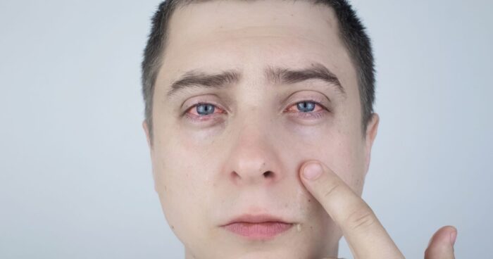 You can recognise itchy eyes from allergies by watering, redness, swelling, and a burning sensation around the eyes.
