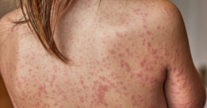 After sun exposure, an itchy rash in the form of red patches may appear on the skin.